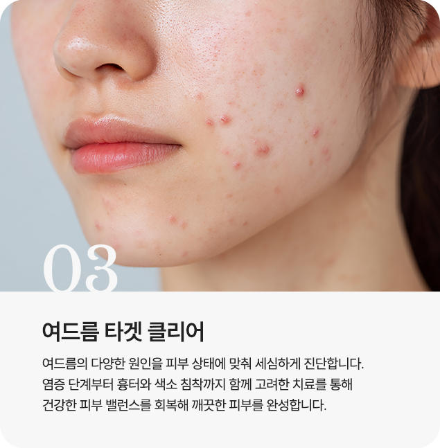 여드름 타겟 클리어