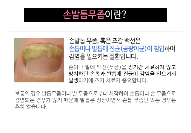 손발톱무좀이란?